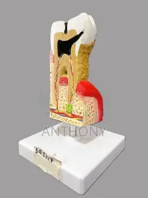 Diseased Tooth Model with Base A542